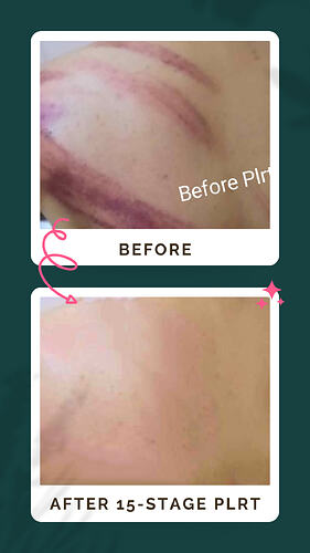 Before and after PLRT