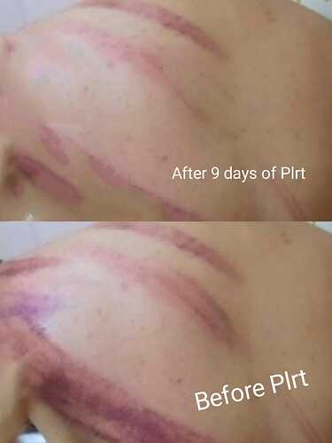 MS client's back hunter marks after 9 days