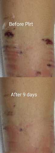 MS client's scar on leg after 9 days